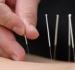 Revive Acupuncture